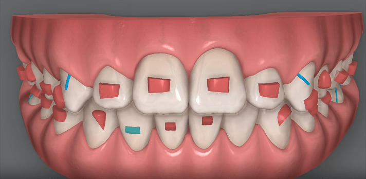 Braces vs. Aligners: Which Option is Right for You?