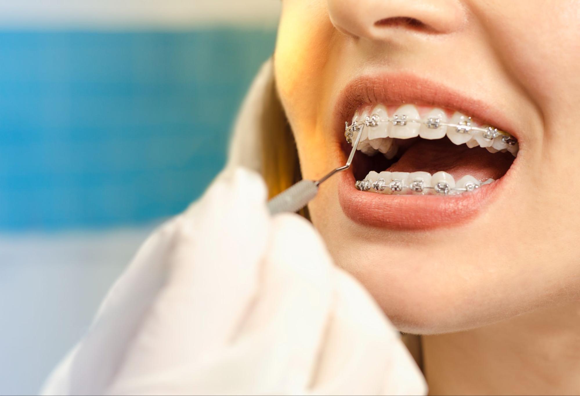 Affordable Orthodontic Options in Unley & Hahndorf