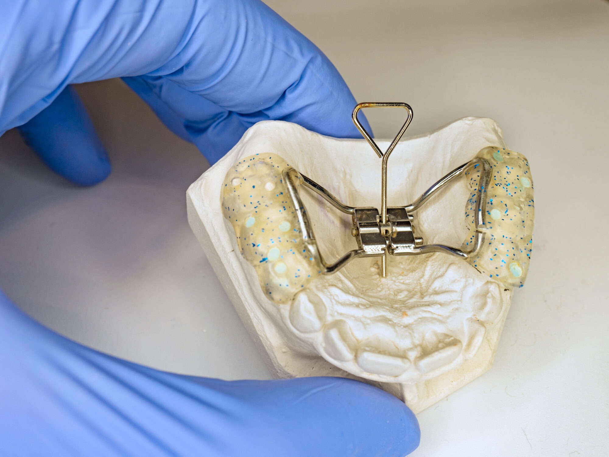 Palatal expander, a modern Phase I treatment option from your Adelaide orthodontist.